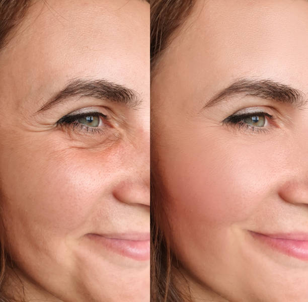 Softens fine lines & wrinkles